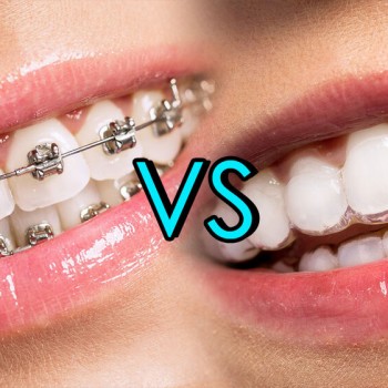 Alternativa all'apparecchio tradizionale